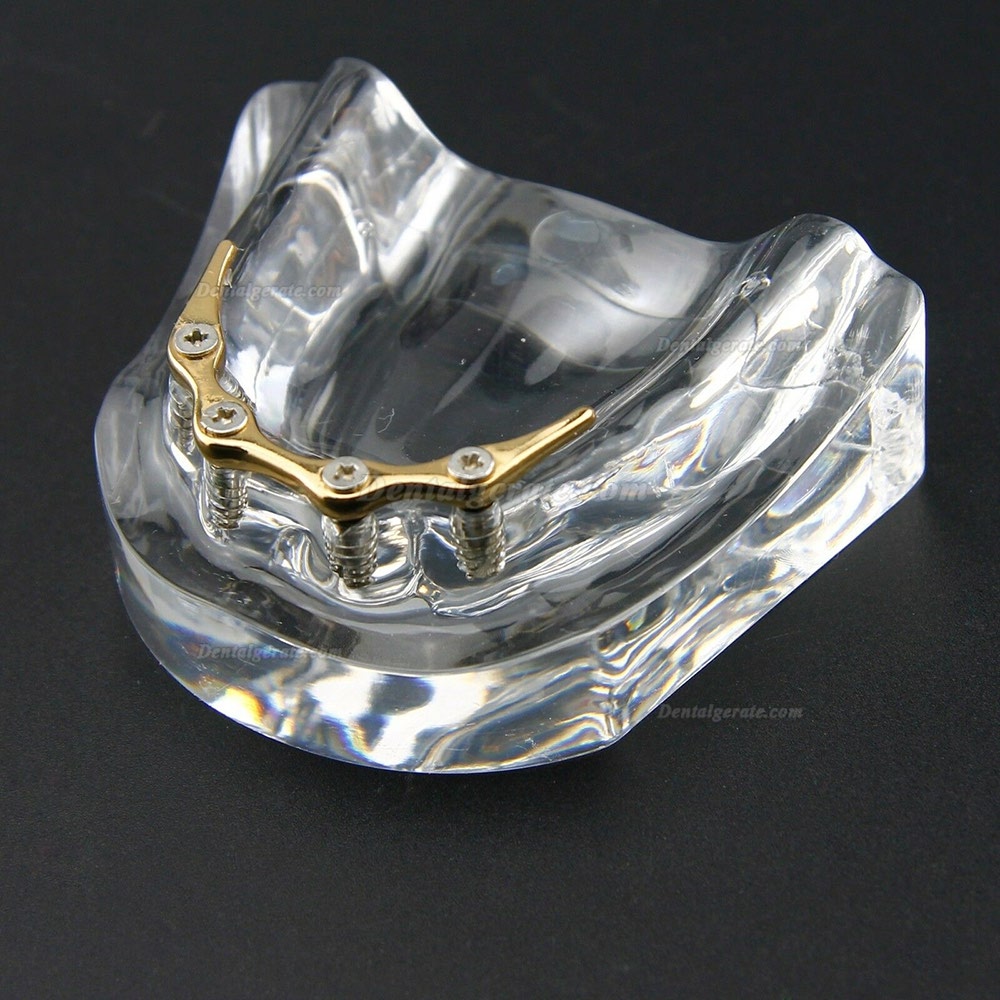 Dental Overdenture Typodont Modell Minderwertiges Pr&auml;zisionsimplantat Golden 6009